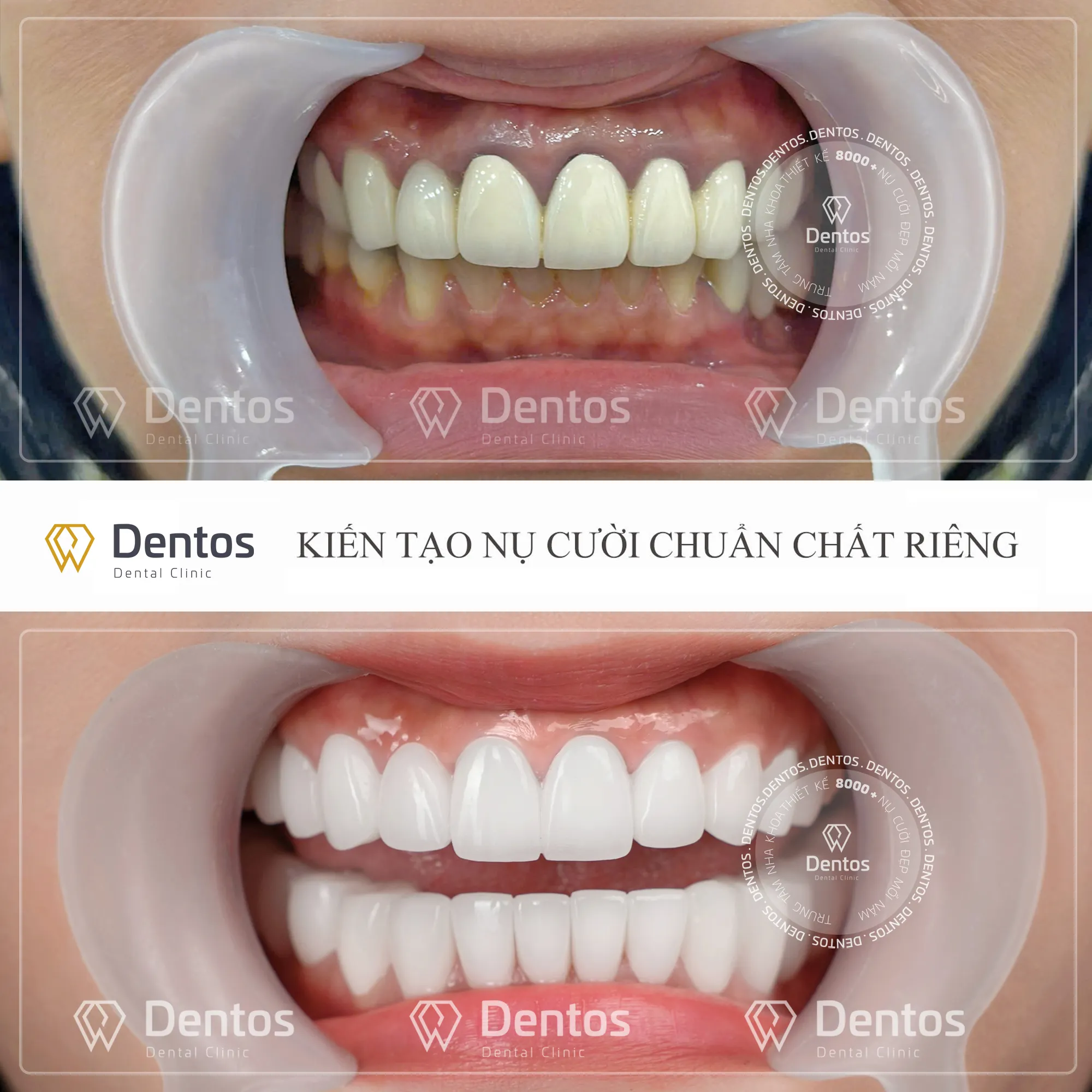 Nha sĩ sẽ cân nhắc thay sứ kim loại bằng răng toàn sứ để tránh tình trạng hôi miệng